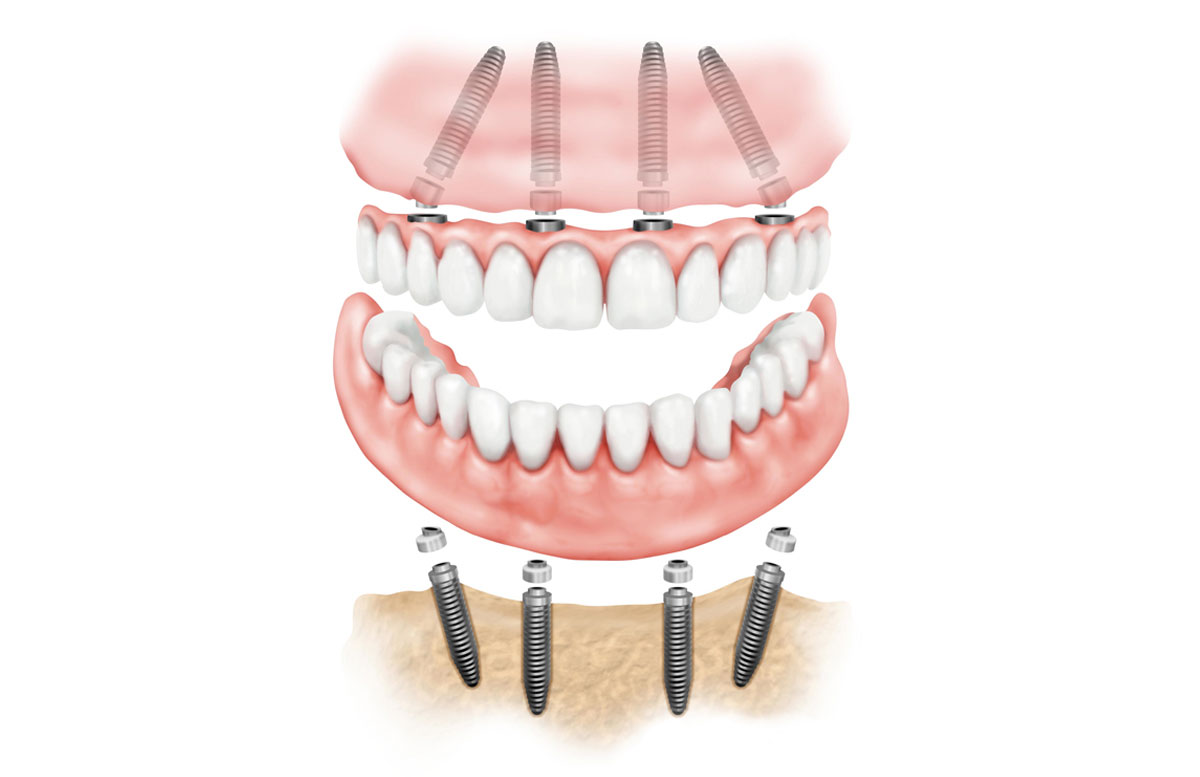 Протез на имплантах при полном отсутствии. Имплантация челюсти на 4 имплантах. Технология имплантации зубов all-on-4.