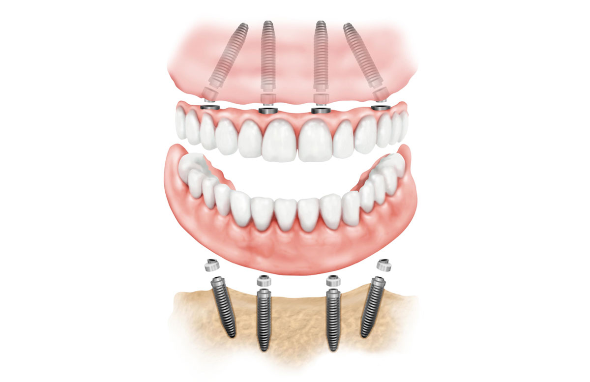 Протезы на 4х имплантах