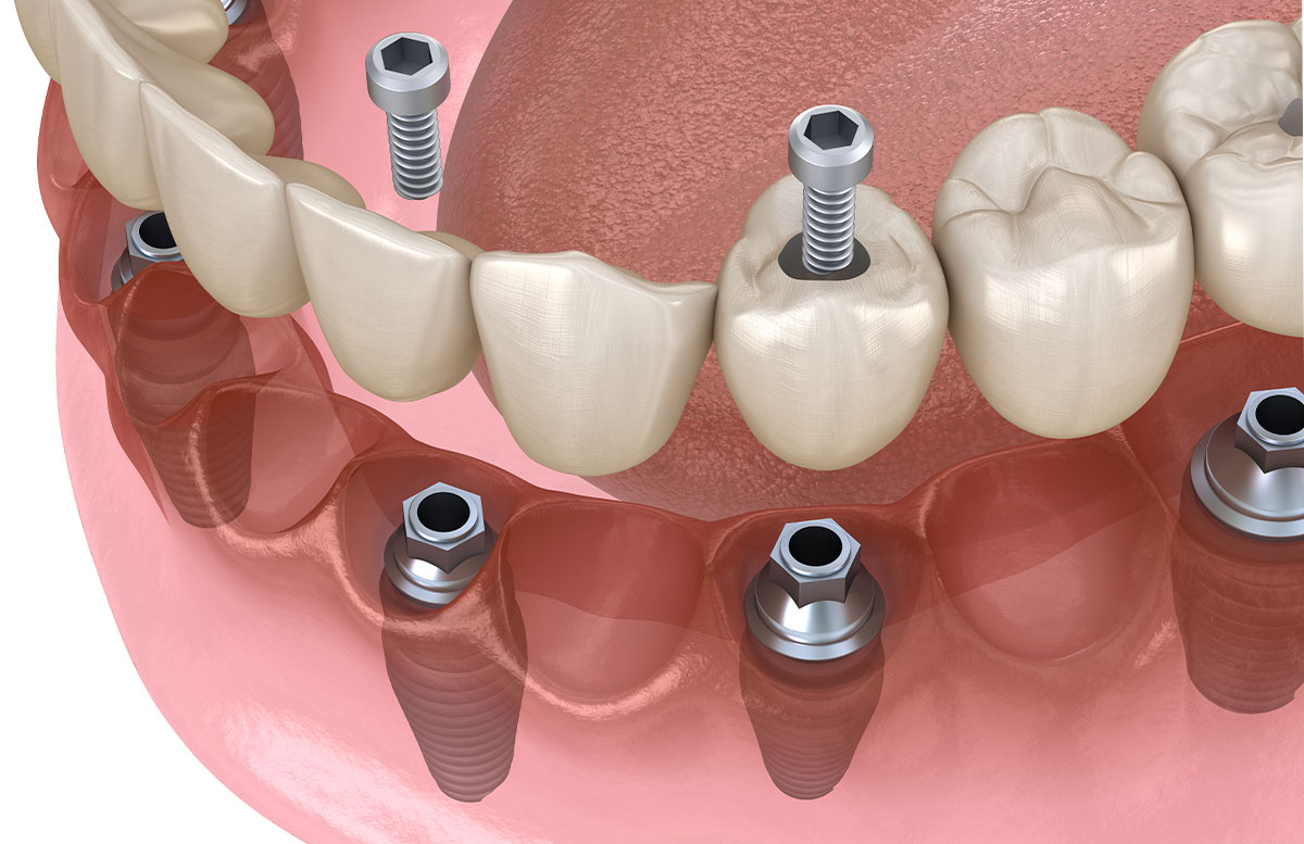 Image of a mouth showing dental implants with screws coming through tops of teeth