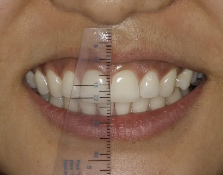 Measuring teeth for a gummy smile using a ruler