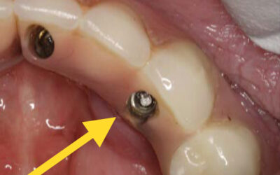 Screw Fractures In Dental Implants