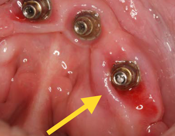 Screw-Fracture-Implant-Removal